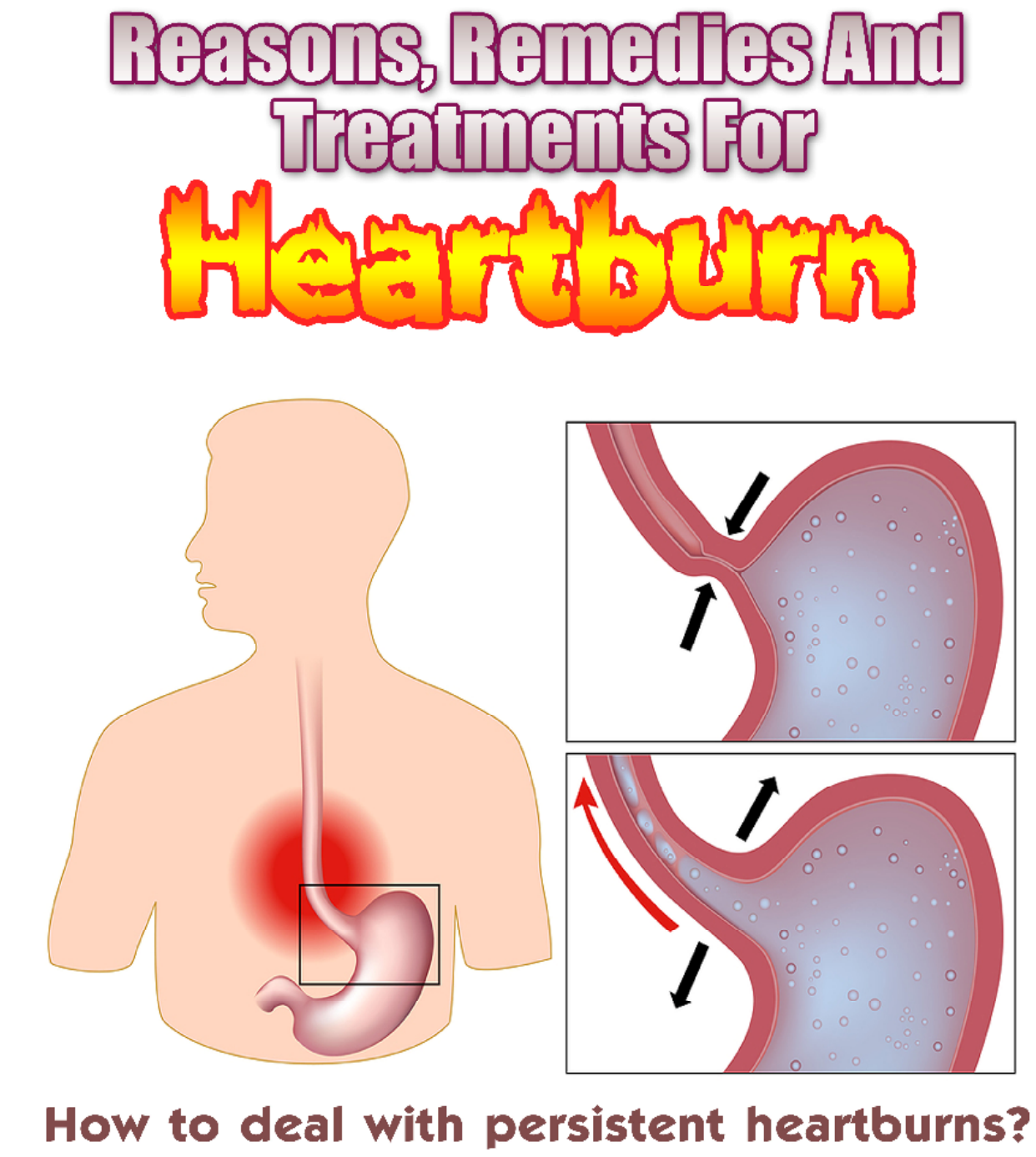 Reasons, Remedies and Treatments for Heartburn
